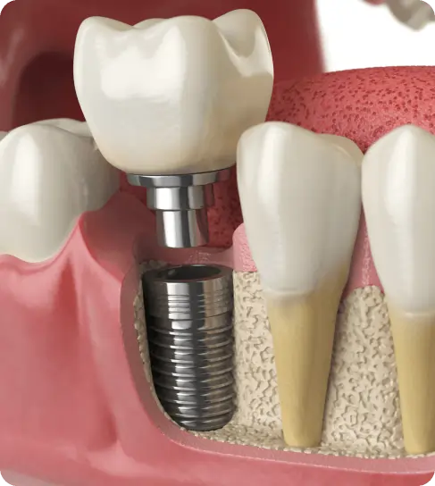 Dental Implants
