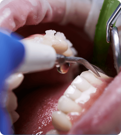 Periodontal Therapy