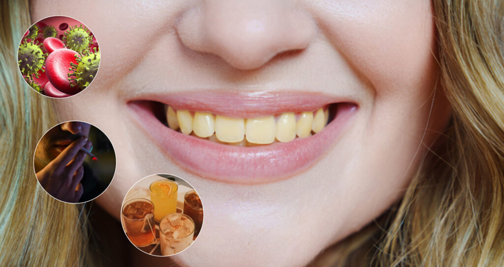 Causes of Yellow Teeth