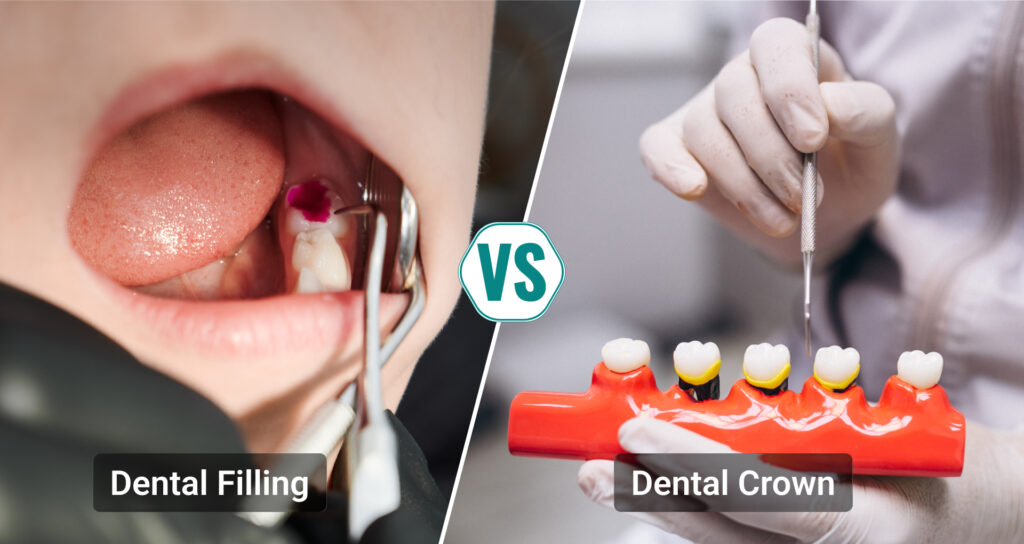 Dental Crown or Fillings