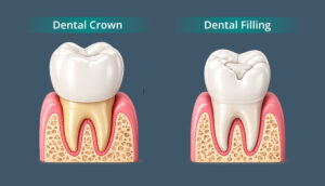 Differences Between a Crown and a Filling