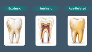 Types of Tooth Discoloration