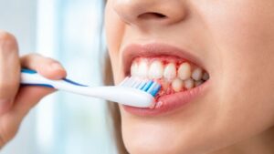 Gums Bleed while Brushing