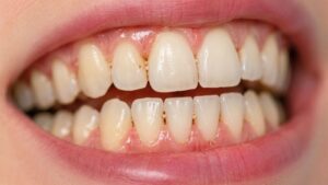 Poor Cleaning Between the Teeth